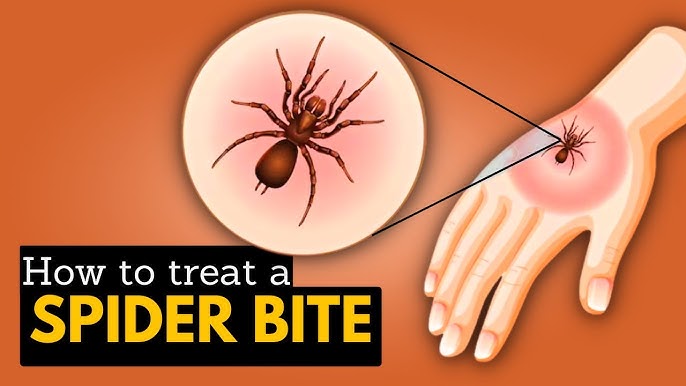 How to Treat a Jumping Spider Bite