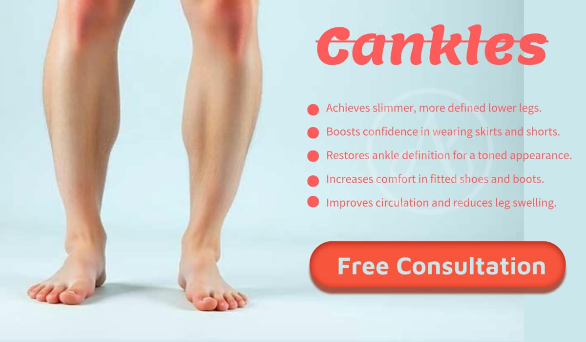 What Are Cankles