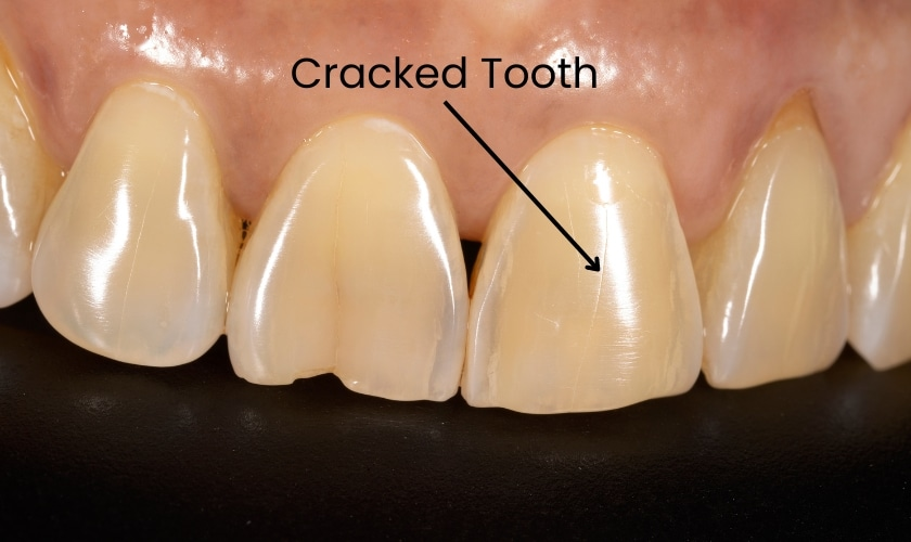 Tooth Cracked in Half No Pain